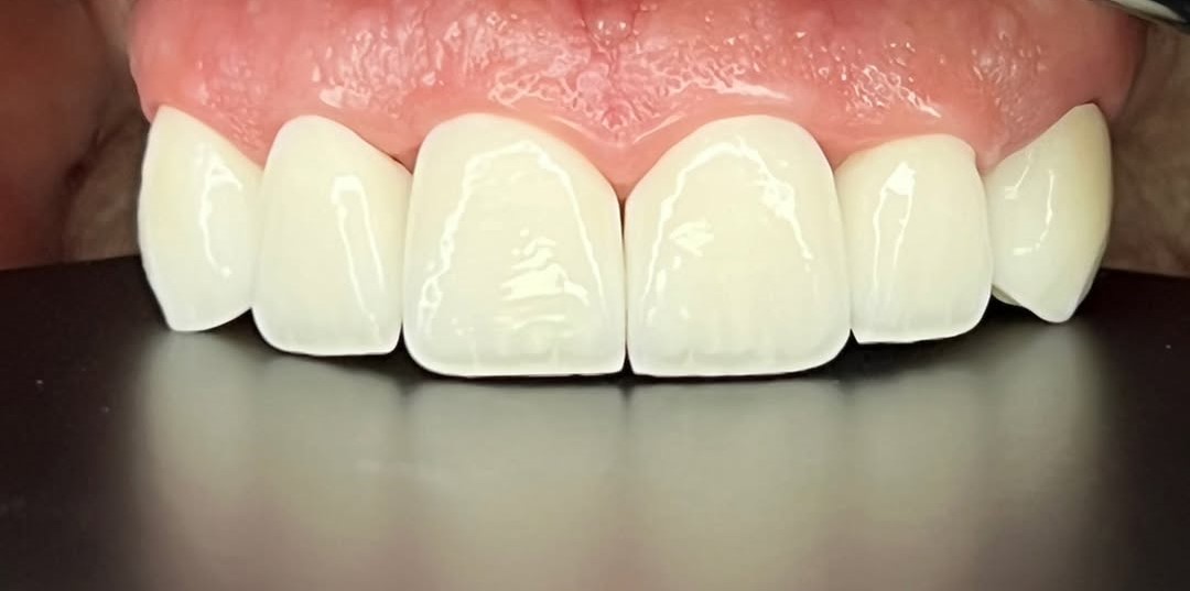 Après — Cas clinique 4